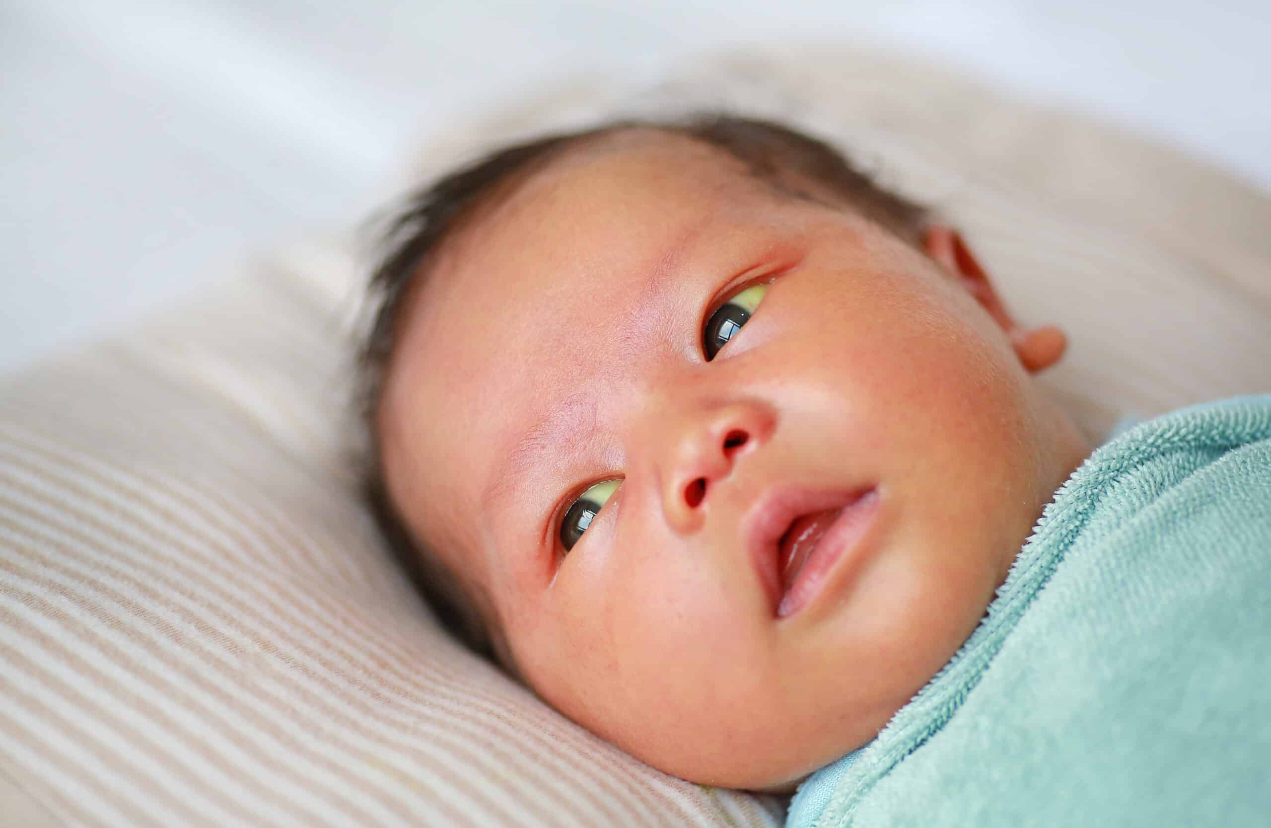 Neonatal jaundice diagnosis, BiliDx, DCN Dx